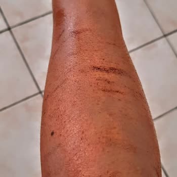 Dilan Polat Estetik Ankara Şubesinde Acılı Ve Dikkatsiz Hizmet