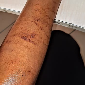 Dilan Polat Estetik Ankara Şubesinde Acılı Ve Dikkatsiz Hizmet