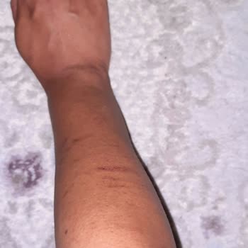 Dilan Polat Estetik Ankara Şubesinde Acılı Ve Dikkatsiz Hizmet