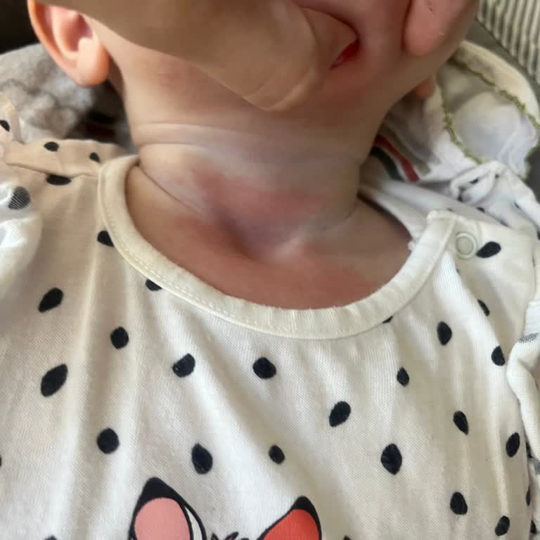 Uni Baby Islak Mendil Alerjisi