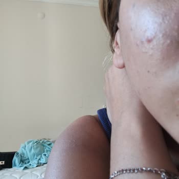 Neutrogena Krem Yüzümü Yaktı