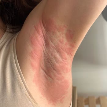 Nivea Deodorant Tahriş Etti