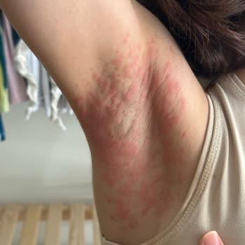 Nivea Deodorant Tahriş Etti