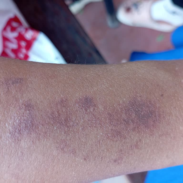 Aris Güzellik Merkezleri Konya Meram Deneme Atışında Oluşan Yanıklar