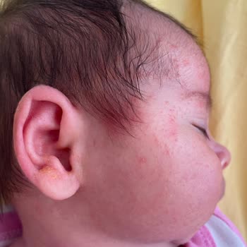 Mustela Şampuan Kızımda Alerji Yaptı