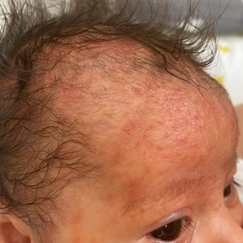 Mustela Şampuan Kızımda Alerji Yaptı