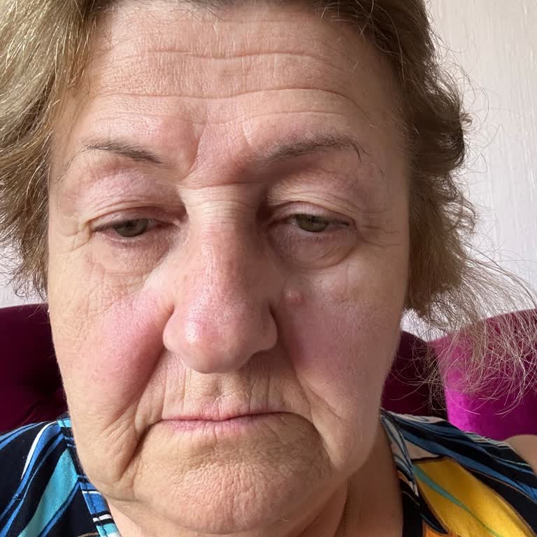 Yves Rocher Yüzde Kaşıntı Ve Yanma Yapan Ürünler