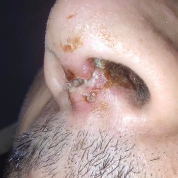 İzmir Tınaztepe Buca Hastanesi KBB Ameliyatı Sonrası Yaşanan Sorunlar Ve Deneyimler