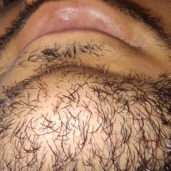 İzmir Tınaztepe Buca Hastanesi KBB Ameliyatı Sonrası Yaşanan Sorunlar Ve Deneyimler