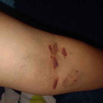 Etlik Şehir Hastanesi Kızılay Kan Bağışı Tecrübesizliği