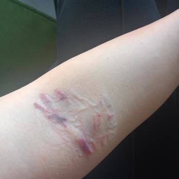 Etlik Şehir Hastanesi Kızılay Kan Bağışı Tecrübesizliği