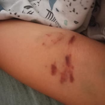 Etlik Şehir Hastanesi Kızılay Kan Bağışı Tecrübesizliği