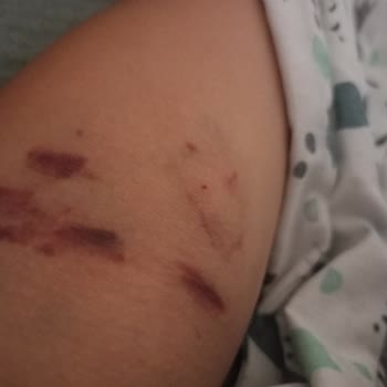 Etlik Şehir Hastanesi Kızılay Kan Bağışı Tecrübesizliği