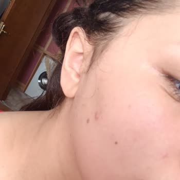 La Roche-Posay Sunscreen Causing Acne Breakouts on My Face