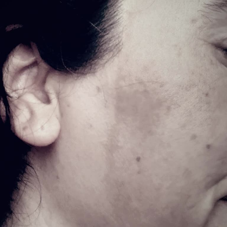 Novar Poliklinik Dökülme Olmadı Ve Yüzümde Lekelenmeler Oldu