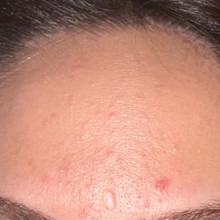 Yves Rocher Sivilce Komedon Çıkarttı