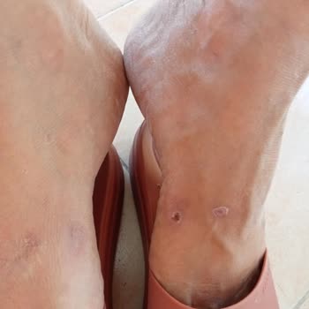 Crocs Terlik & Ayakkabı Yara Yapıyor Terlik