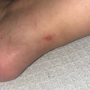 Ziya Mağazacılık Sandaletlerde Yaşanan Rahatsızlık Ve Müşteri Hizmetleri Sorunu