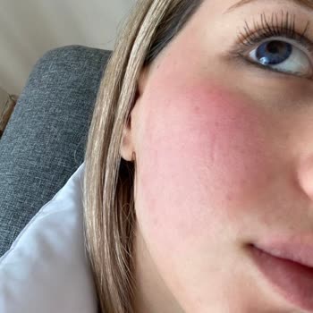 Bee Beauty Bee Beuty Marka Maske Yüzümü Yaktı