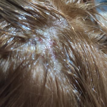 Palette 10.1 Saç Boyası Kafa Derisi Yanması