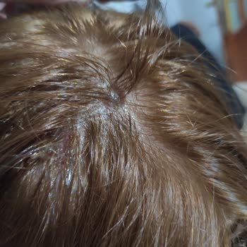 Palette 10.1 Saç Boyası Kafa Derisi Yanması