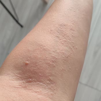 Eda Taşpınar Bronzlaştırıcı Yağ Alerji Yaptı