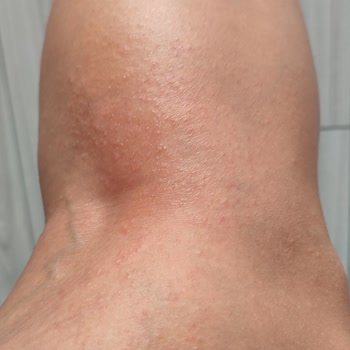 Eda Taşpınar Bronzlaştırıcı Yağ Alerji Yaptı