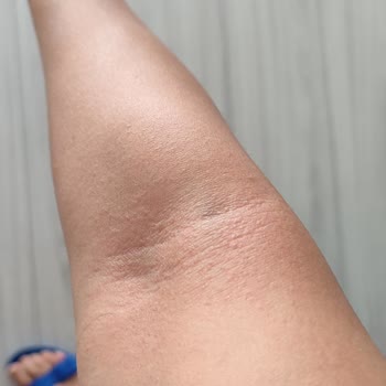 Eda Taşpınar Bronzlaştırıcı Yağ Alerji Yaptı