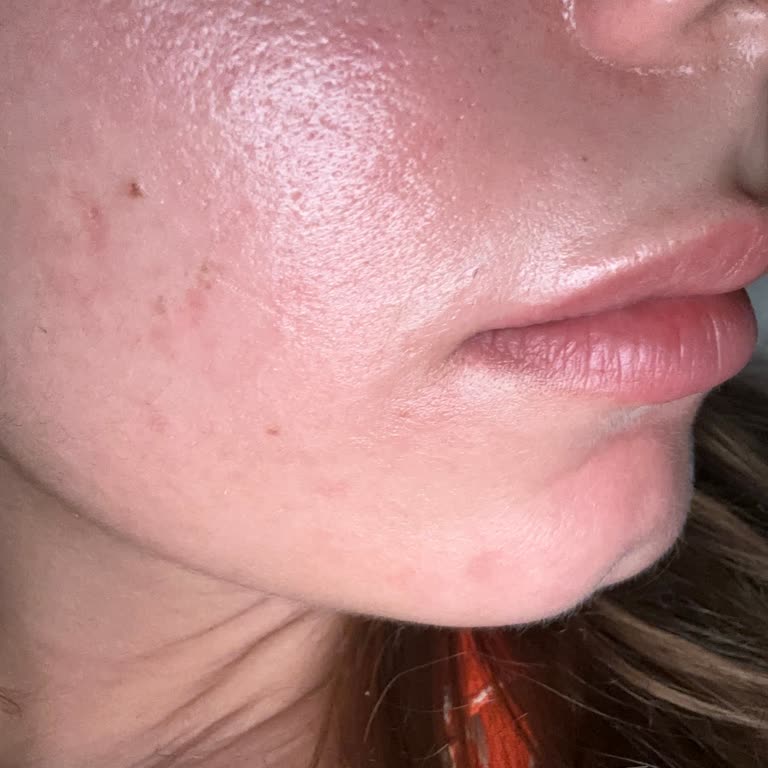 Bioderma Pigment-bio Serum Cildimi Kıpkırmızı Yaptı