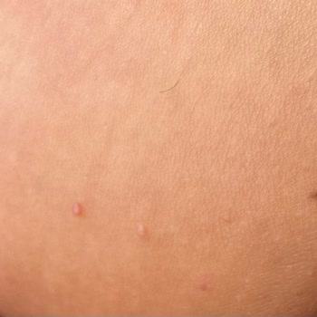 Eda Taşpınar Kremleri Alerji Ve Yanık Yaptı