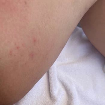 Eda Taşpınar Kremleri Alerji Ve Yanık Yaptı