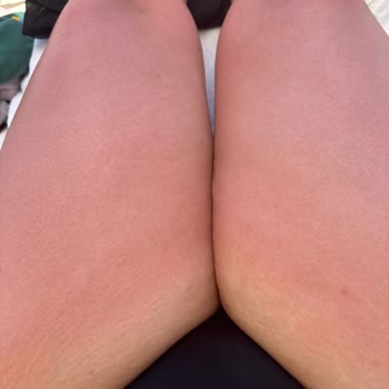 Eda Taşpınar Kremleri Alerji Ve Yanık Yaptı