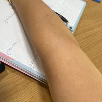 Lotus Beauty Ankara Lazerde Kollarım Yandı