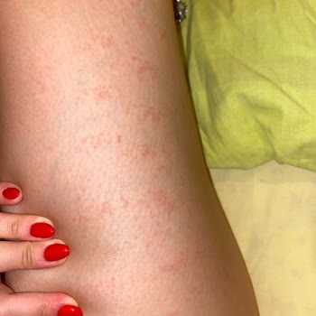 Lotus Beauty Ankara Lazerde Kollarım Yandı