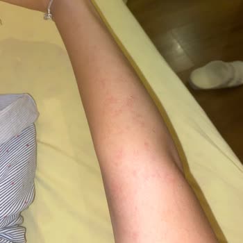 Lotus Beauty Ankara Lazerde Kollarım Yandı