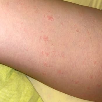 Lotus Beauty Ankara Lazerde Kollarım Yandı