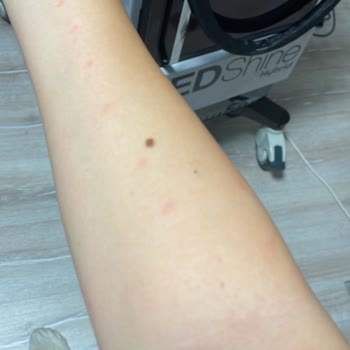 Lotus Beauty Ankara Lazerde Kollarım Yandı