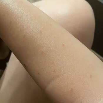 Lotus Beauty Ankara Lazerde Kollarım Yandı