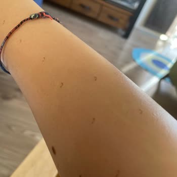 Lotus Beauty Ankara Lazerde Kollarım Yandı