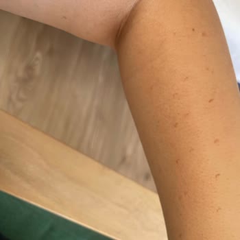 Lotus Beauty Ankara Lazerde Kollarım Yandı