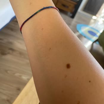 Lotus Beauty Ankara Lazerde Kollarım Yandı