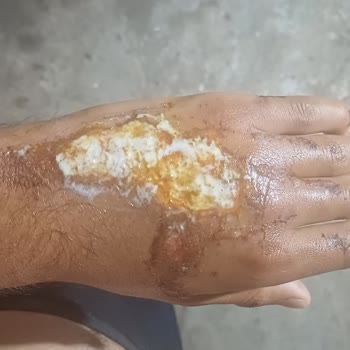 Aksigorta Kalıcı İzlerim Olmasına Rağmen Başvurumu Reddetti