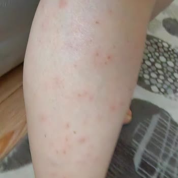 Sevgi Medlife Estetik Epilasyon Sonrası Kabarcık Oluştu!