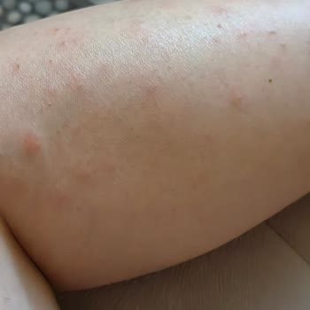 Sevgi Medlife Estetik Epilasyon Sonrası Kabarcık Oluştu!