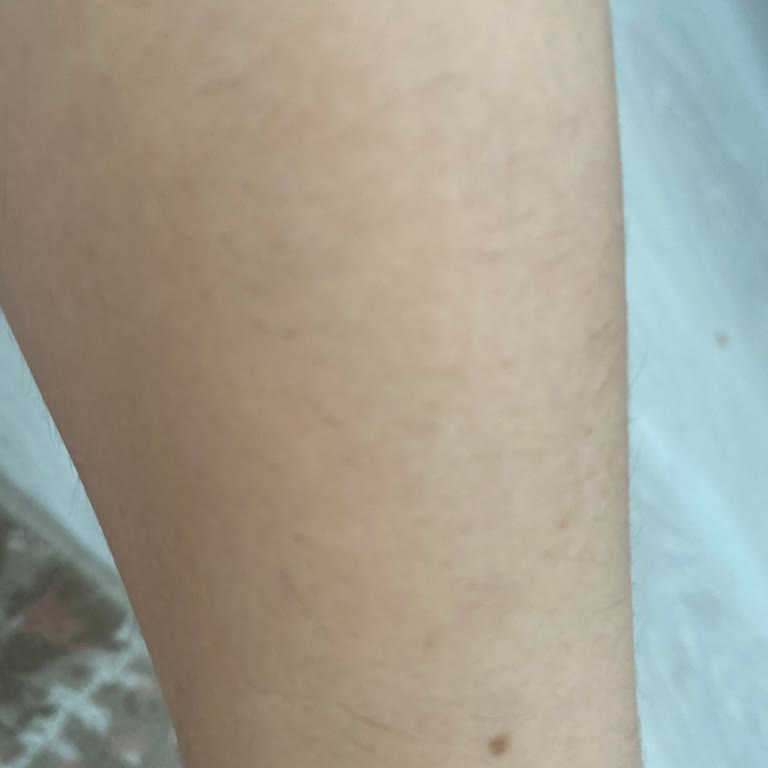 Dila Sayan Lazer Epilasyon Sonrası Hayal Kırıklığı