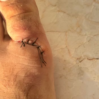 Villabi Talihsizliği, Tatilimizi Hastanede Geçirdik