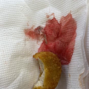 Burger King Nugget İçinden Çıkan Tehlikeli Sivri Kemik Parçası