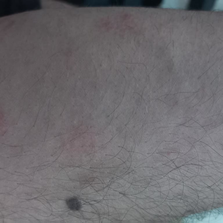 İbrahim Etem İlaç 1000mg Antibiyotik Kullanımı Sonrası Yan Etkiler