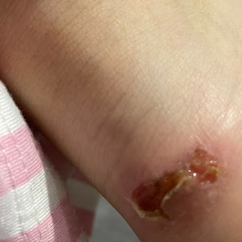 Calvin Klein Ayakkabı Aldım Kızımın Ayağını Yara Yaptı