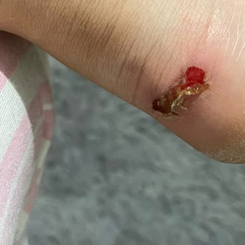 Calvin Klein Ayakkabı Aldım Kızımın Ayağını Yara Yaptı